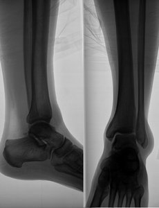 X-ray beeld van het been